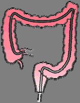 Endoscopy Crohn s