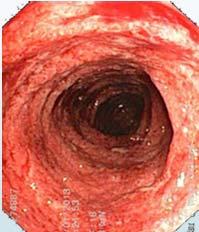 Ulcerative Colitis Mucosal inflammation confined to colon Bloody