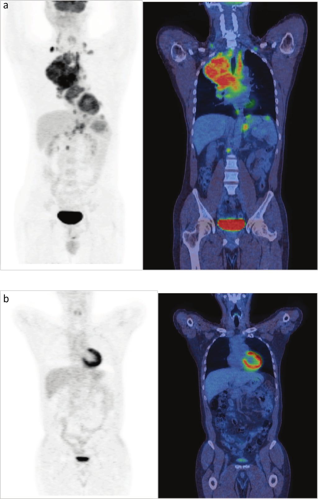 PET/CT in clinical oncology 18F-FDG The oncological applications of PET/CT imaging are wide (Table 1).3 18F-FDG has high sensitivity but is not tumour-specific.