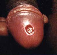 Syphilis Primary ulcer or chancre at infection