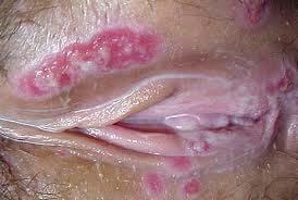 Chancroid Painful genital ulcer + inguinal lymphadenopathy H.