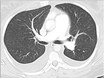 PA Loss of retrosternal airspace RV enlargement CT-Chest: Pulmonary Dilation CT-Chest: RA, RV,