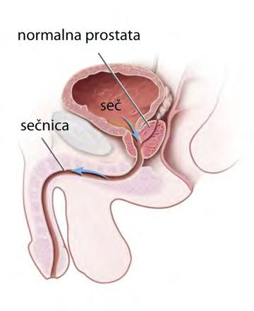 2 8 9 ZMOTE Težave z odvajanjem seča so prvi znak raka prostate. Sperma, obarvana s krvjo, je znak raka. Izcedek iz sečnice pomeni bolezen prostate.
