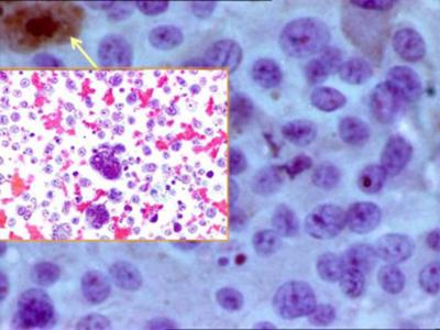 Figure 5 Table 2: Uncommon Metastasis To Head & Neck Lymph Nodes Figure 6 Figure 4: FNA smear showing metastasis of malignant melanoma.
