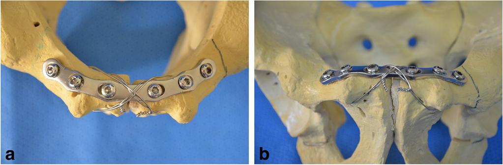 Park et al. BMC Musculoskeletal Disorders (2017) 18:40 structures in the Retzius space during the making of holes for wire passage in the body of the pubis with a drill.