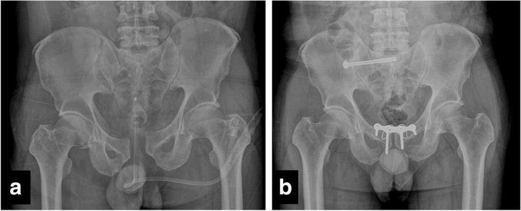 Park et al. BMC Musculoskeletal Disorders (2017) 18:40 Page 5 of 6 Fig. 3 Plain pelvis radiograph. a Preoperative image of a 36-year-old male patient after pelvic ring injury (61-B1).
