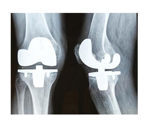 Knee surgery, once considered a last resort, is now conducted on over 700,000 individuals in the U.S. each year.