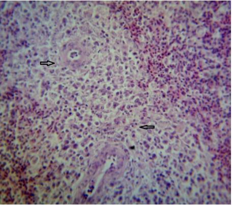 the follicles showed marked lymphocytic depletion exposing the cortico-medullary layer. In some follicles the medulla had cystic cavities containing eosinophilic fluid (Plate V).