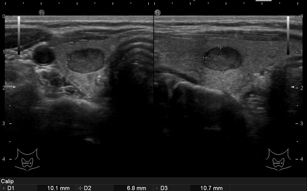 Clinical case #2 31 yrs Thyroid ultrasound screening at routine gynecological visit Detection of two thyroid