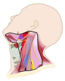 pretracheal, paratracheal, prelaryngeal, delphian N 1b Metastases to unilateral, bilateral or contralateral cervical or superior mediastinal lymph nodes Modified Neck