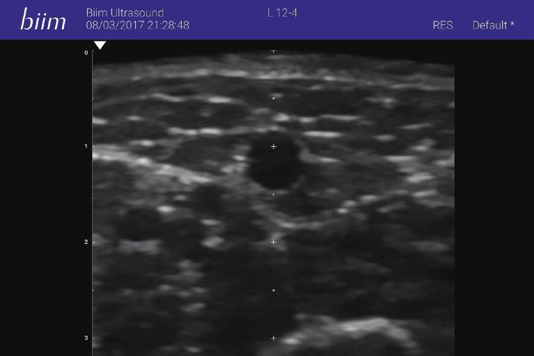 Evidence-based guidelines recommend ultrasound to assess and access veins Ultrasound guidance in venous access is recommended in the clinical practice guidelines of many organizations, including:
