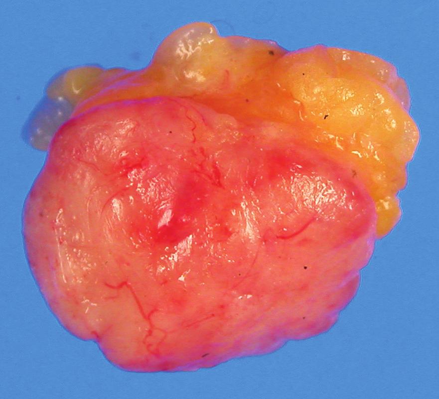 Twenty-six months after surgery, the patient remains in good health, with no evidence of recurrence or metastasis. DISCUSSION Soft tissue perineurioma is a distinctive type of peripheral nerve Fig. 1.