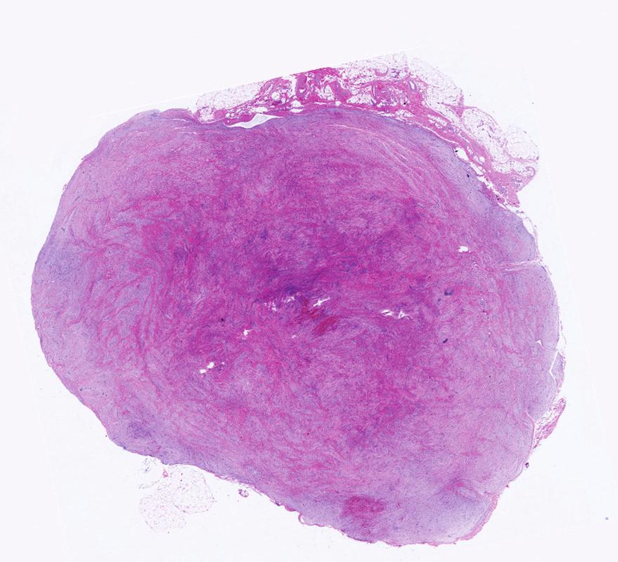sheath tumor composed of perineurial cells.