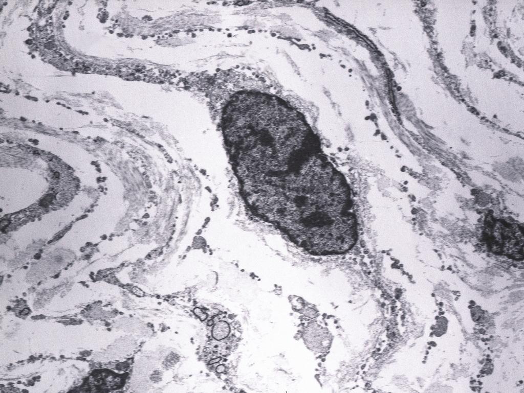 (A) The spindle cells are arranged in fascicular pattern