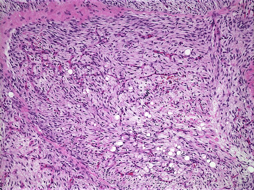 Spindle cell Liposarcoma