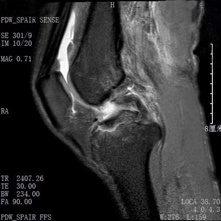 avulsion, but the displacement was not dealt with because it was not evident.