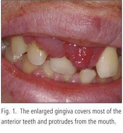 Gingival hyperplasia is a common problem observed during the first 6