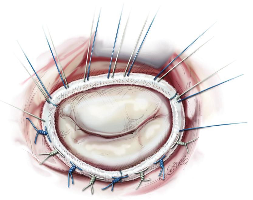 Annals of cardiothoracic surgery, Vol 2, No 6 November 2013 823 Figure 11 Implanted annuloplasty ring with the sutures partially knotted. Figure 12 Left atriotomy closure.