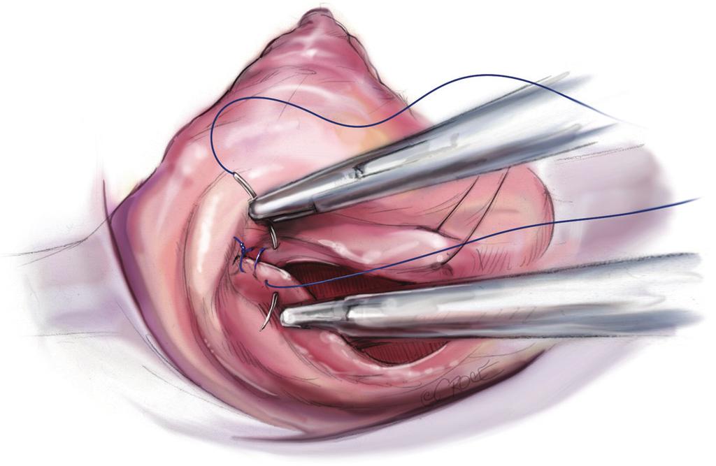 If there is no backflow from the ventricle and the mitral valve smiles at the surgeon, a successful repair can be assumed (Figure 11).