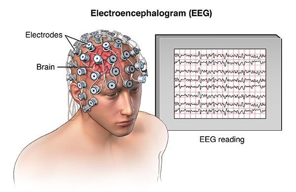 Diagnosis Electroencephalogram (EEG) is the most common test used to diagnose epilepsy Electrodes placed on the patient s scalp record electrical activity of neurons Even when not having a seizure,
