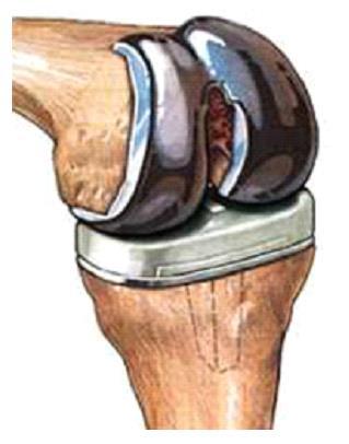 A PATIENT S GUIDE TO REHABILITATION POST KNEE REPLACEMENT SURGERY Georgia Bouffard