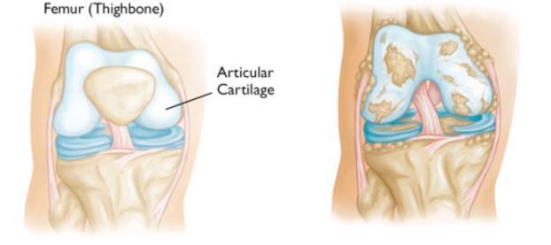 WHY DO YOU NEED A KNEE REPLACEMENT? Knee replacement surgery is suited for people suffering from advanced arthritis or damage to the joint by trauma, fractures, or congenital deformities.