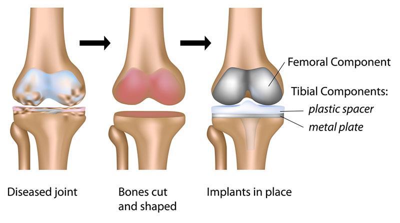 ABOUT THE SURGERY Knee replacement, also called arthroplasty, is a surgical procedure to resurface a knee damaged by arthritis.