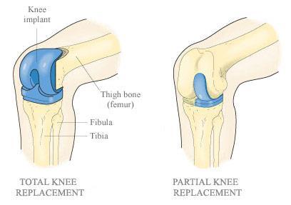 A total knee replacement completely replaces the articular surfaces of the femur, tibia and patella and removes the cruciate ligaments.
