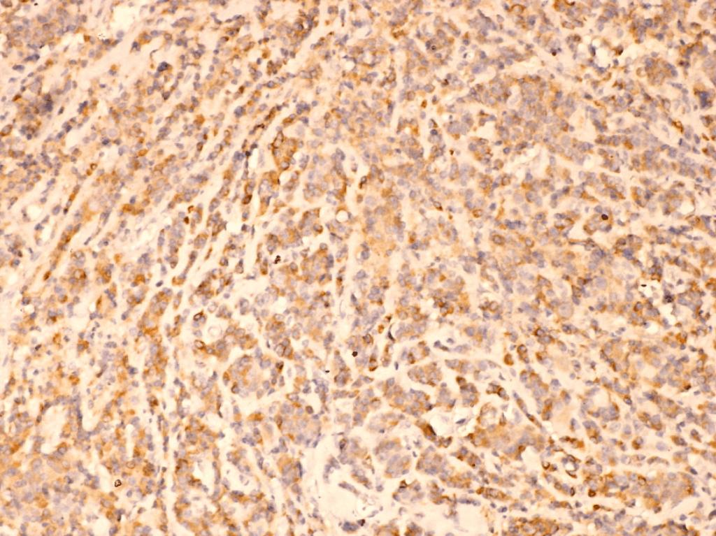 Figure 3 Infiltrating lobulary carcinoma. Moderate positive immunostaining for Bcl- (ob. ). Figure Molecular type of tumors.