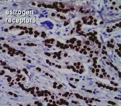 Hormone Receptor (ER/PR+)/HER2- breast 50% of breast cancers Increasing