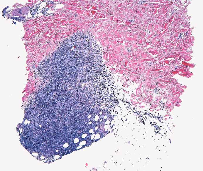 A B C D Image 5 Histologic sections of the lymphocytic variant of the hypereosinophilic syndrome reveal superficial and deep dermal lymphocytic infiltrates, often extending into underlying