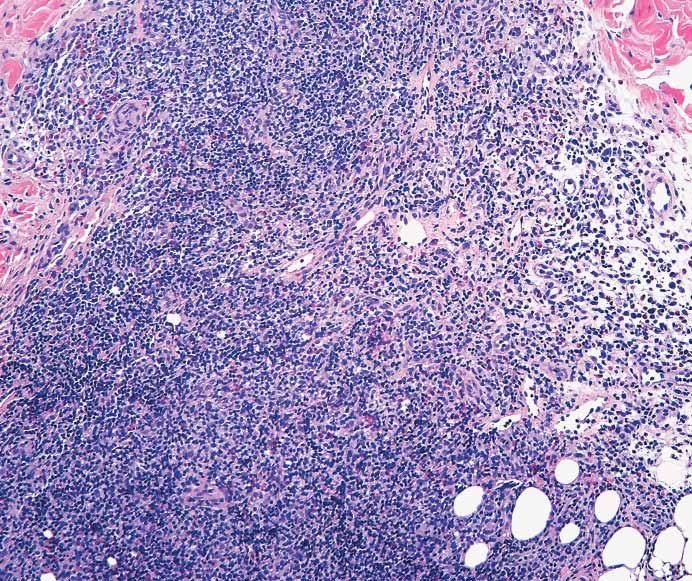Close examination of the inflammatory infiltrate reveals large and small lymphocytes with a prominent subpopulation of associated eosinophils (C and D, H&E). (Case 297, courtesy of Marsha C.