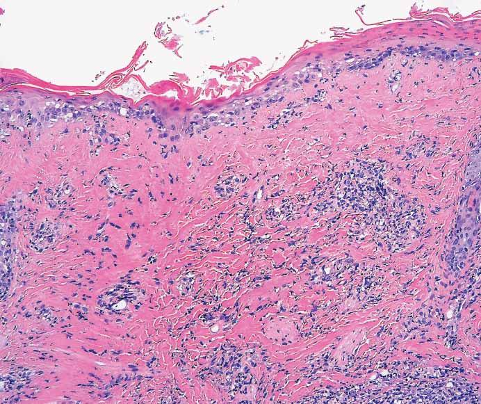 Sarantopoulos et al / Mimics of Cutaneous Lymphoma A B C D Image 6 Cutaneous biopsies of Kikuchi-Fujimoto disease typically show changes of interface dermatitis (erythema multiforme or lupus-like),