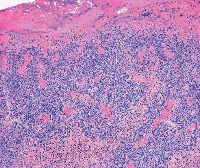 A B C D Image 7 Histologic sections of traumatic ulcerative granuloma with stromal eosinophils often show somewhat nonspecific findings, which include ulceration and ulcer bed overlying a superficial