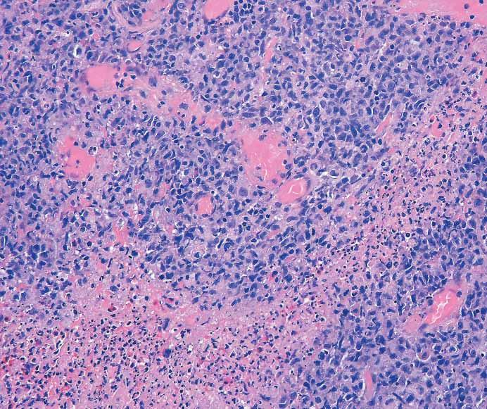 High magnification of histiocytes highlights often-observed nuclear irregularity (D, H&E). A variable population of enlarged (typically CD30+) lymphocytes (not shown) is also observed (H&E).