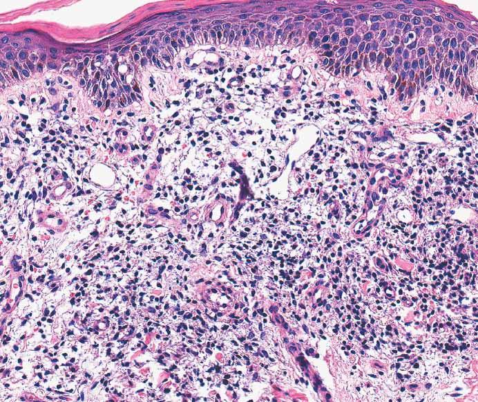 Sarantopoulos et al / Mimics of Cutaneous Lymphoma A B C Image 8 Histologic sections of pigmented purpuric dermatosis reveal evidence of lymphocytic vasculitis, including lymphocytes surrounding