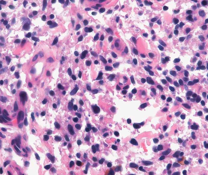 Higher magnification reveals some variation in the size and shape of associated lymphocytes (B, H&E). Often, special staining for iron is performed to help highlight dermal hemosiderin deposition.