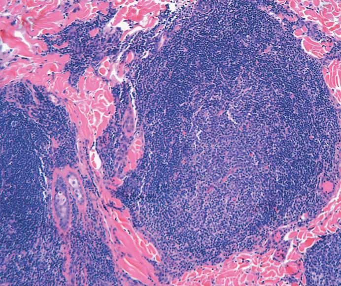 ) Usually, lymphoid follicles will also retain a wellformed mantle zone (C and D, H&E). (Case 211, courtesy of Gulsah Kaygusuz, MD, and Isinsu Kuzu, MD.