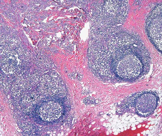 positive T-cell gene rearrangement in 1 case. However, other supporting features of malignancy, including aberrant immunostaining patterns or systemic findings, were not apparent.