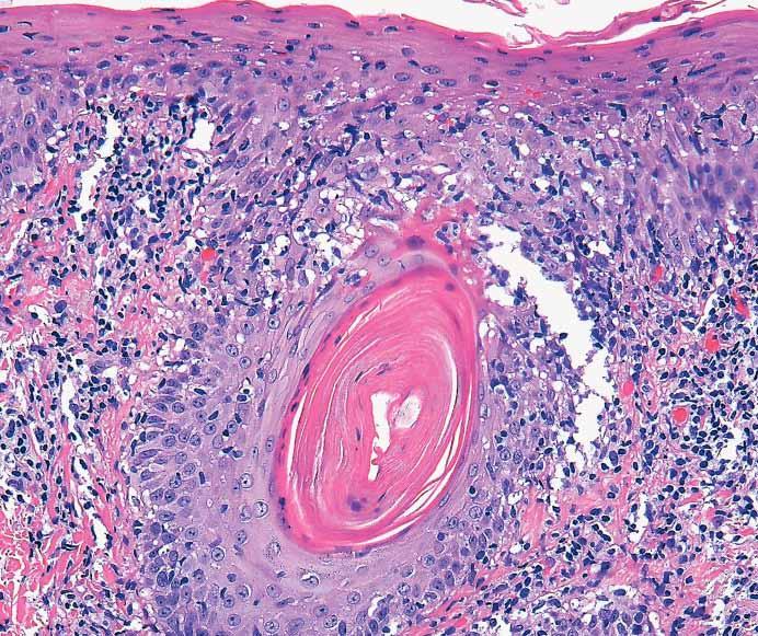 Intraepidermal lymphocytes, many exhibiting irregular nuclear contours, may coalesce to mimic Pautrier microabscesses (aka pseudo-pautrier abscesses) (D, H&E). (Case 227, courtesy of Scott Binder, MD.
