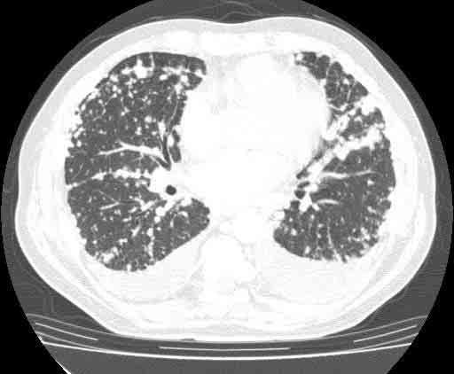 Although ronchoscopy ws Fig. 2, ) Chest CT on dmission, demonstrting multiple shdows in oth lung fields. Fig. 1 Chest rdiogrphy on dmission showing multiple nodules in oth lungs.
