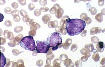 Acute leukaemia Accumulation of blasts in the bone marrow Classification of Acute leukaemia The following tests are essential for