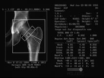 bone strength BMD explains > 70% of whole bone strength in ex vivo human cadaver studies Bouxsein 1999 Femoral Strength (N) 10000 8000 6000 4000 2000 Proximal Femur (sideways fall) r 2 = 0.71 0 0 0.
