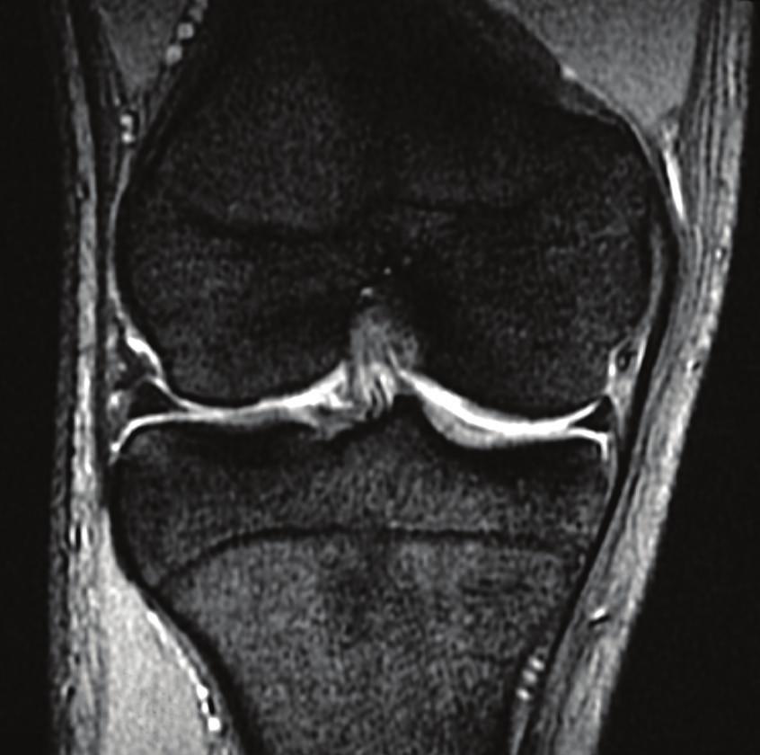 2 Case Reports in Orthopedics Figure 1: T2-weighted coronal magnetic resonance image of the right knee.