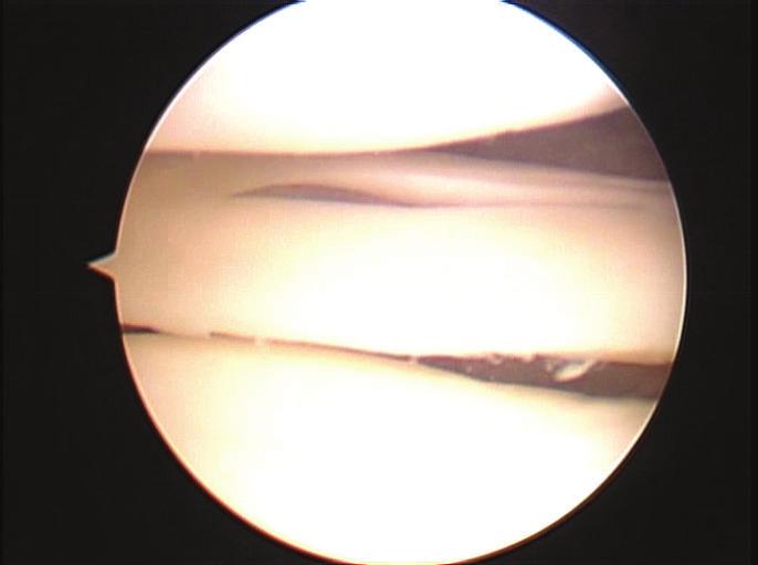 Upper accessory meniscus of posterior (a) and middle (b) segments.