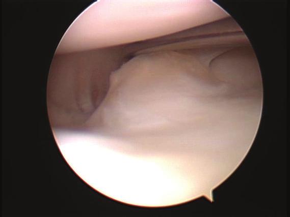 Case Reports in Orthopedics 3 Figure 3: Arthroscopic views of the right knee. Meniscocapsular separation at overlapping middle segment of the double-layered lateral meniscus.