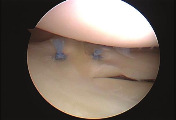 bilateral and two were accompanied by a discoid lateral meniscus (Table 1). The clinically reported prevalence of a double-layered lateral meniscus varies from 0.06% to 0.09% [5, 6].