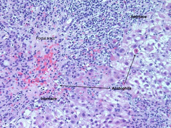 infiltrate with lymphoid aggregates, including germinal centers Few, scattered acidophilic bodies Lymphoplasmacytic portal infiltrate Mild or no lobular hepatitis Steatosis Balloon hepatocytes