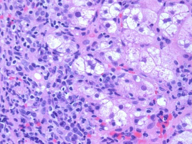 This image (hematoxylin-eosin, 3400) shows rosettes. activity (Fig. 4). Rosettes and plasma cells are typical but are not pathognomonic or consistently seen.