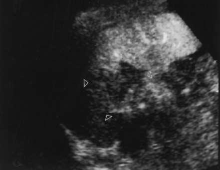 A, Unenhanced oblique sonogram at the level of the splenic lower pole showing subtle